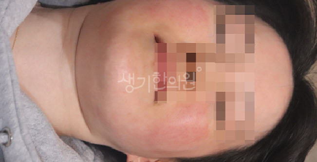 지루성피부염 피지분비 막아도 계속되는 이유