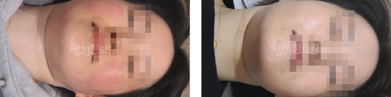 지루성피부염 피지분비 막아도 계속되는 이유