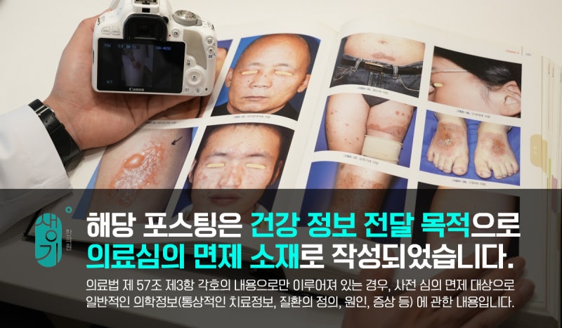 눈밑 한관종 치료 어떻게 해야할까