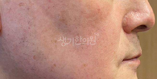 안면홍조 피부과 증상 심해지기 전 일상 관리 방법은?