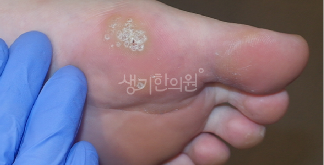 족저사마귀 뿌리를 뽑아야 재발을 막아