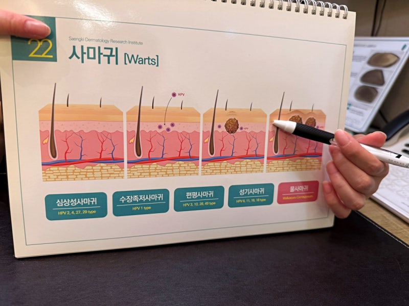 족저사마귀 뿌리를 뽑아야 재발을 막아