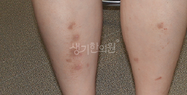 건선 증상 악화와 면역계 독소와의 상관관계