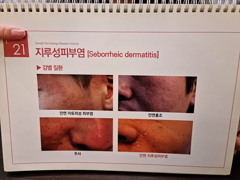 성인 지루성두피염 사회생활 속 과로와 만성 피로가 부르는 피부과 증상