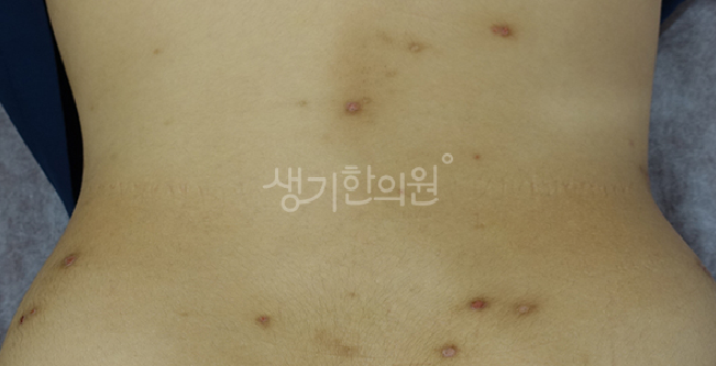 나이가 들면서 갑자기 마주하게 된 성인아토피 증상 성인기 악화 요인 차단법