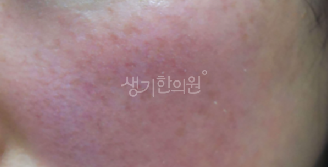 사당동피부과질환 안면홍조 더워서 생기는게 아니다?