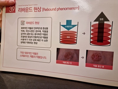 장 건강과 직결된 만성 두드러기 원인 소화기 독소의 누적 과정