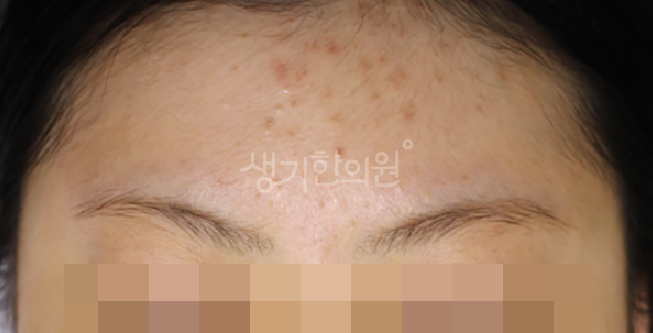여드름 자국이 붉게 지속될 때 의심해야 할 피부 장벽 상태는?