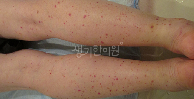 자반증 완화에 도움 되는 일상 속 혈액순환 관리 수칙