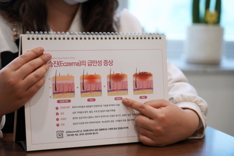 염증을 유발하는 기름진 식단 습진 식습관 가이드로 바로잡기