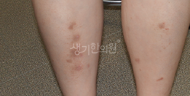건선 피부과 질환 헷갈리기 쉬운 습진 및 한포진과의 명확한 차이점과 감별법