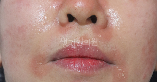 코 주변 지루성피부염 콧볼 사이에 끼는 노란 각질과 붉은기 완화하기