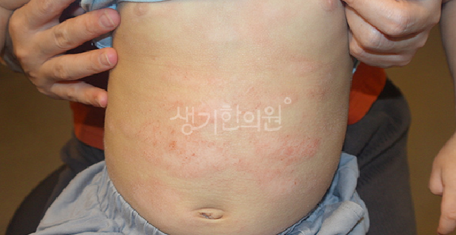 가족력이 있다면 꼭 확인해야 할 아토피 보습 관리법 유아기 대처 프로세스