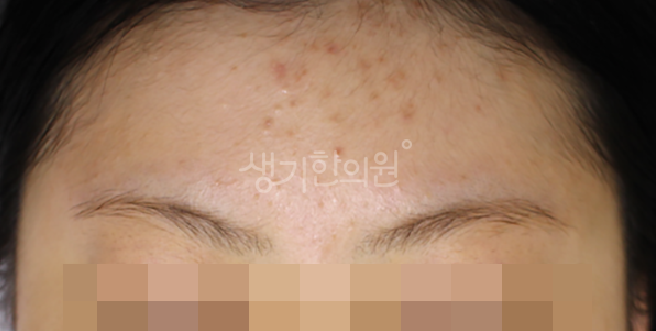 구로디지털단지 근처 피부과증상 여드름 왜 여름에 잘 생길까?