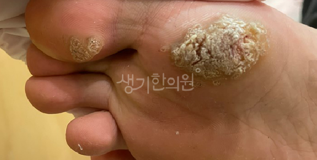 스타킹이나 양말 마찰로 심해지는 발가락 사마귀 증상