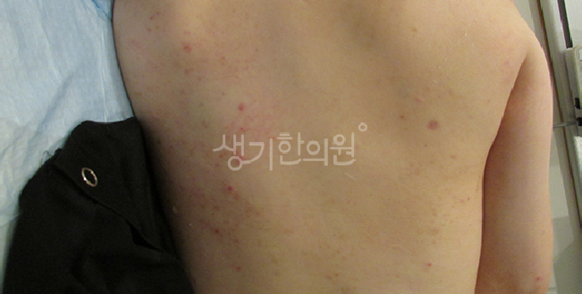 체온 상승과 두드러기 생리학적 관점에서 바라본 피부 팽진 현상