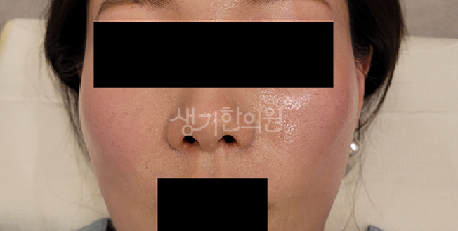안면홍조 완화를 위한 초기 증상 대처법과 급성 발진 대처 가이드