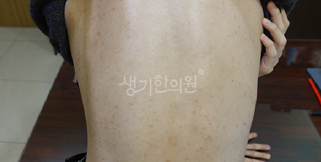 면역력 저하가 유발하는 성인 모낭염 증상의 특징과 예방법