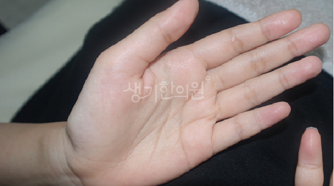다한증 원인이 단순히 더위 때문이 아닐 수 있는 이유