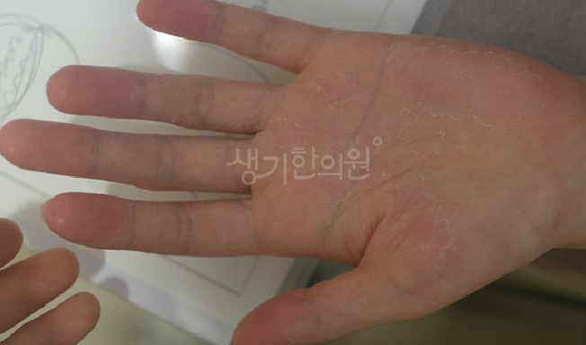 다한증 원인이 단순히 더위 때문이 아닐 수 있는 이유