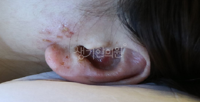 지루성피부염 영유아 피부 변화 아기 머리에 노란 딱지가 앉았을 때
