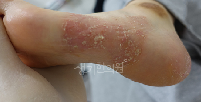 한포진 발바닥 치료법 단계별 정리