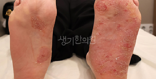 한포진 발바닥 치료법 단계별 정리