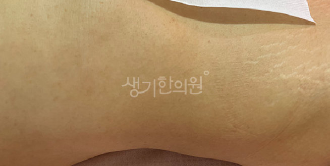 몸 편평사마귀 특징 가슴과 배 주변에 갈색 반점처럼 번지는 증상