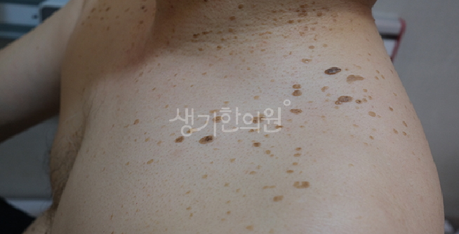 몸 편평사마귀 특징 가슴과 배 주변에 갈색 반점처럼 번지는 증상