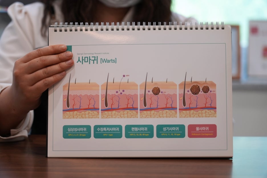 몸 편평사마귀 특징 가슴과 배 주변에 갈색 반점처럼 번지는 증상