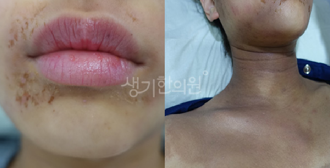 아토피 곰팡이 자극 실내 환경 위생 관리