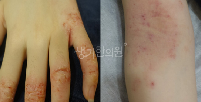 아토피 곰팡이 자극 실내 환경 위생 관리