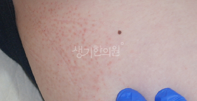 사타구니 습진 가려움 통풍이 안 되어 붉은 발진이 번질 때