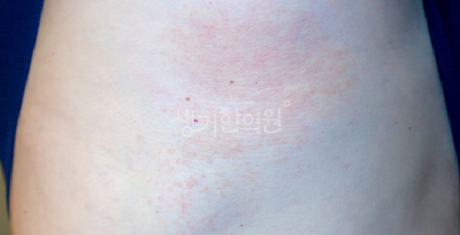 사타구니 습진 가려움 통풍이 안 되어 붉은 발진이 번질 때