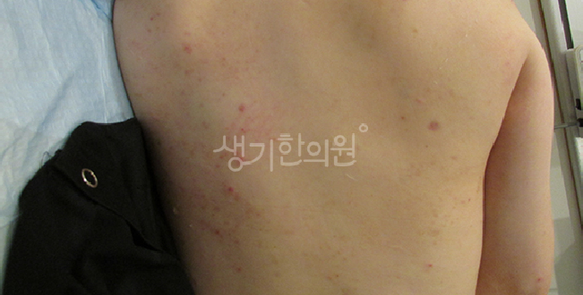 피부알레르기 재발이 잦다면 몸 안쪽 원인부터 살펴야 합니다