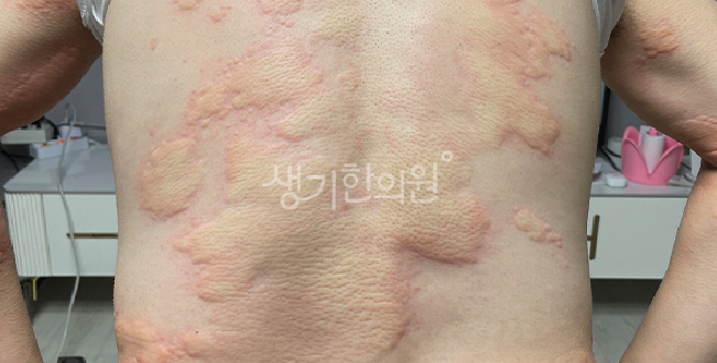 피부알레르기 재발이 잦다면 몸 안쪽 원인부터 살펴야 합니다