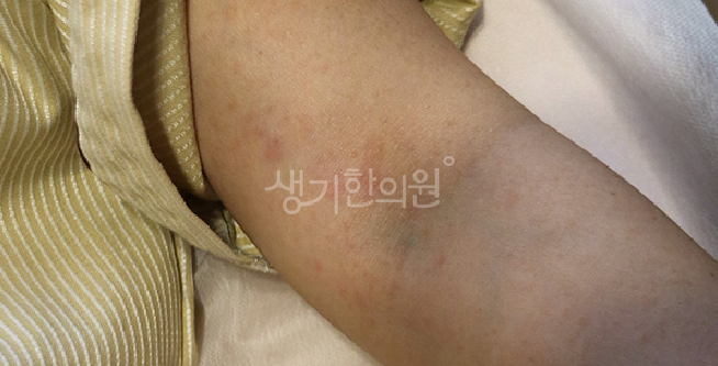 영아 두드러기, 이유식 시작 시기에 집중되는 식품 유발 반응의 특성