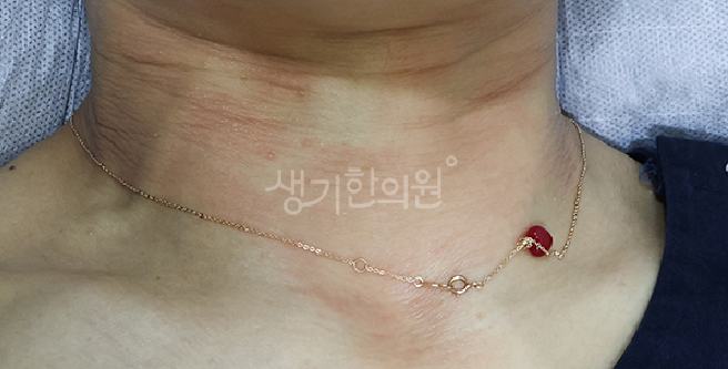 땀을 많이 흘리는 계절에 유독 심해지는 여름철 접촉성피부염 예방 수칙