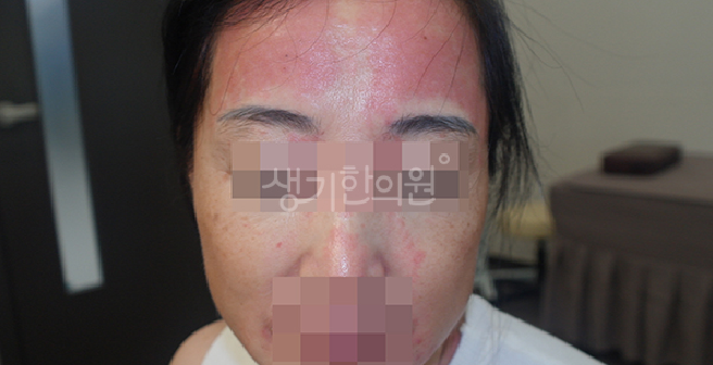 땀을 많이 흘리는 계절에 유독 심해지는 여름철 접촉성피부염 예방 수칙