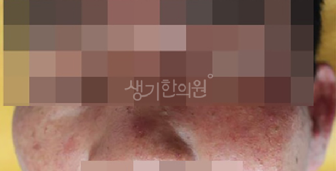 스테로이드 연고 오남용 붉은기 잡으려다 만성 홍조로 이어지는 과정
