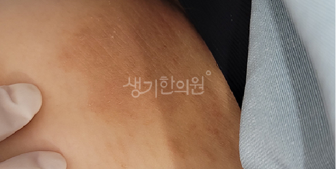 노원역피부과질환 습진 가려움 예방하는 생활습관은?