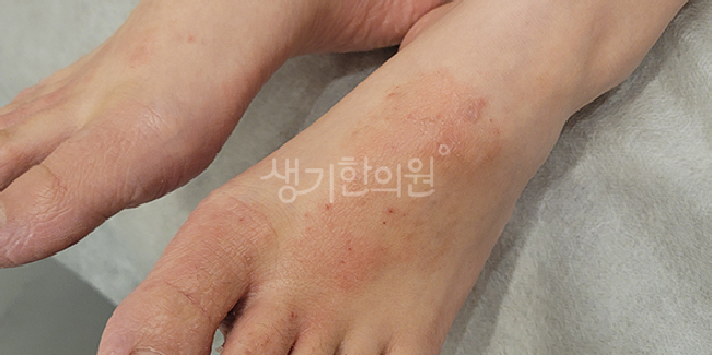 노원역피부과질환 습진 가려움 예방하는 생활습관은?