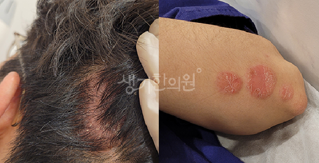 얼굴 건선 초기 증상 늦지않게 구별하는 방법