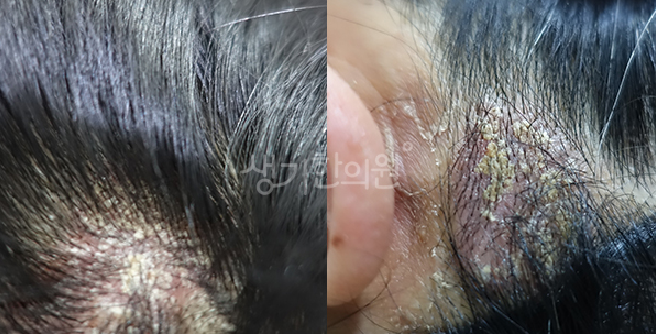 지루성두피염 두피 가려움 긁지 않고 진정시키는 방법