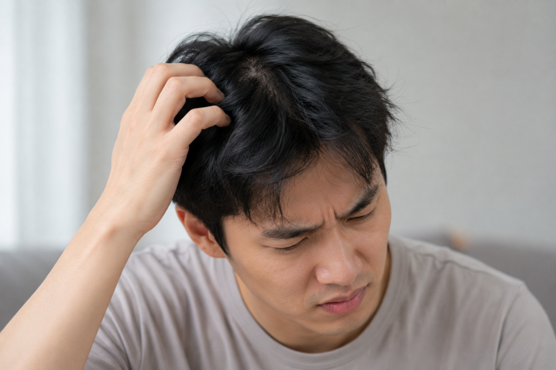 지루성두피염 두피 가려움 긁지 않고 진정시키는 방법