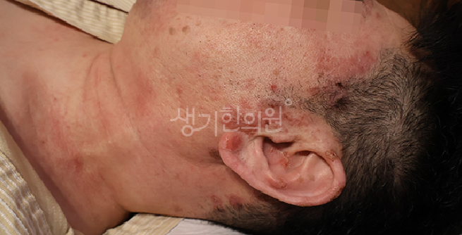 지루성두피염 두피 가려움 긁지 않고 진정시키는 방법