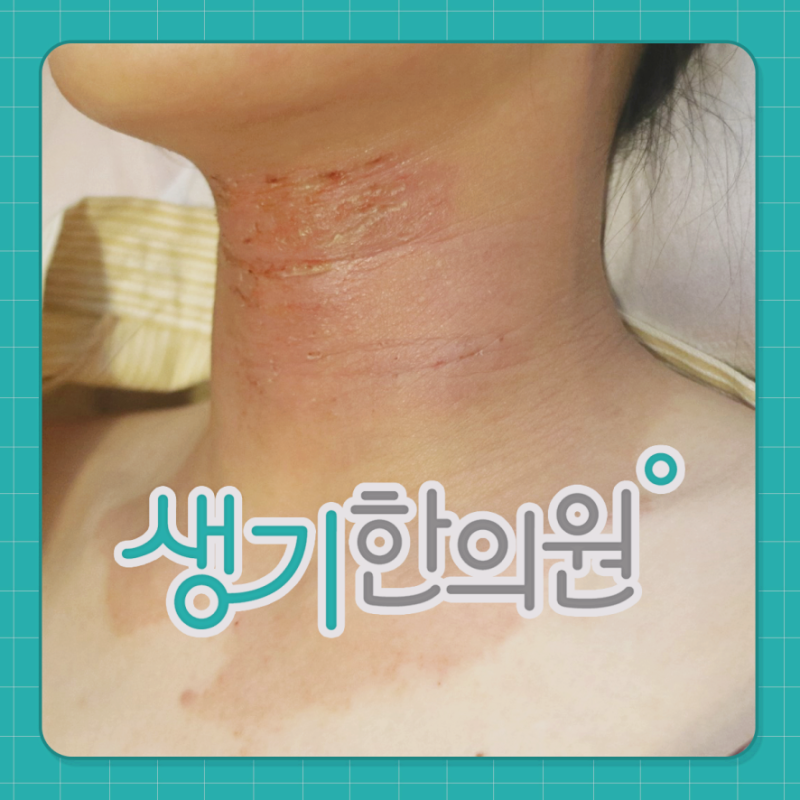 피부가려움증 항히스타민제 효과가 예전보다 떨어졌다고 느껴지는 원인
