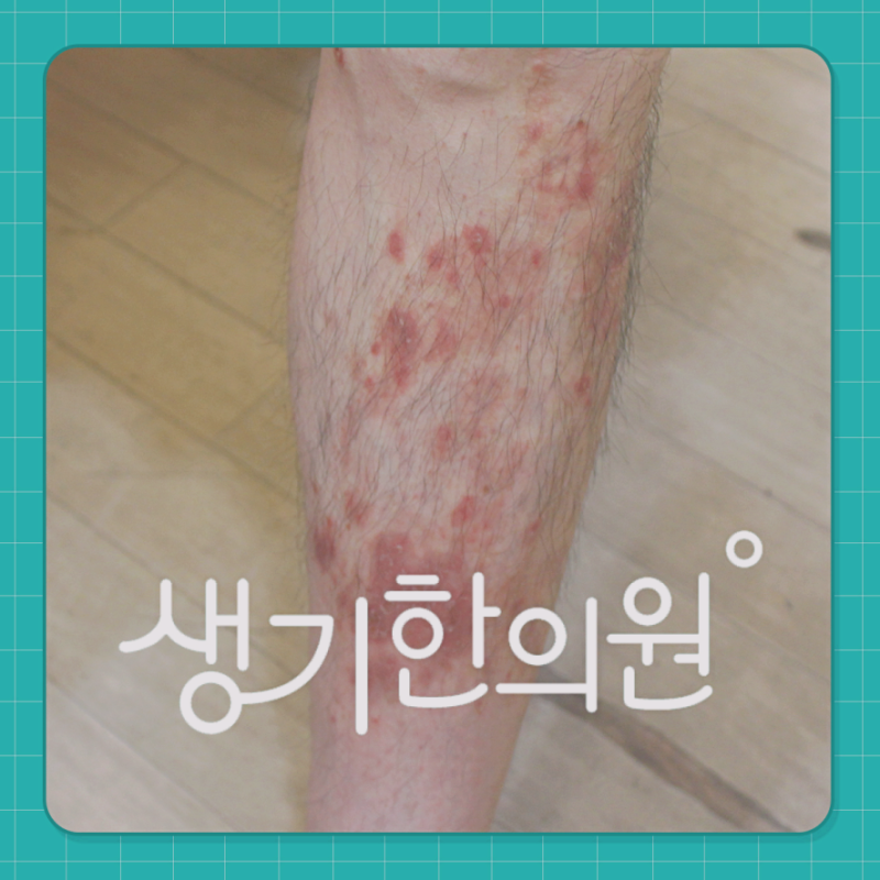 사춘기 청소년의 두드러기, 호르몬 변화가 피부 면역 반응에 미치는 영향