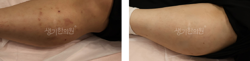 파주운정피부과질환 아토피에 안 좋은 습관은?