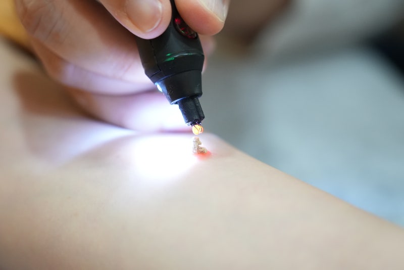 소아 농가진 치료 주의사항, 전염여부까지